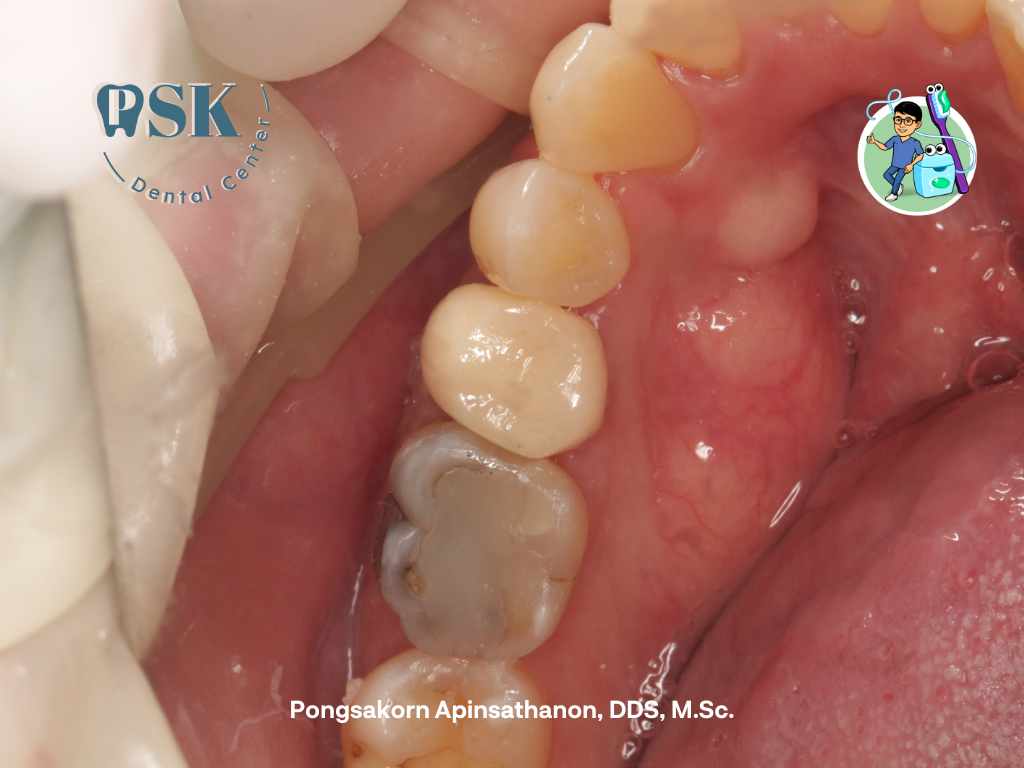 ครอบฟันชั่วคราว ครอบฟัน ที่คลินิกทันตกรรมพีเอสเค ศูนย์ทันตกรรมพีเอสเค PSK Dental Center PSK Dental  Clinic ครอบฟันชั่วคราวสวยเหมือนฟันจริง