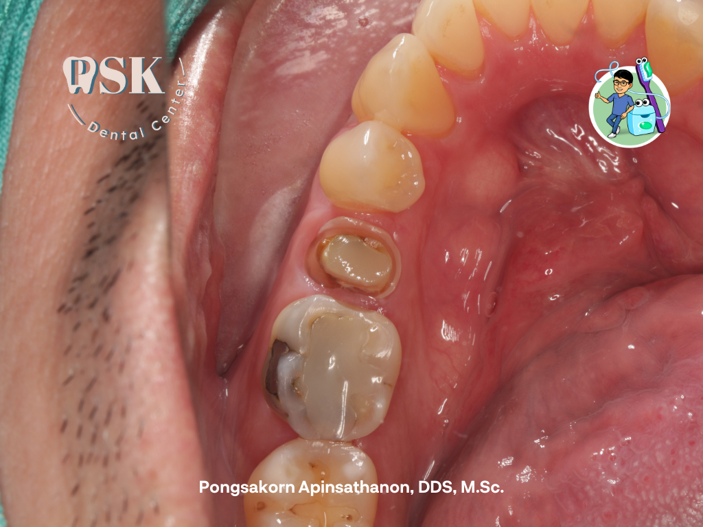 ครอบฟันชั่วคราว ครอบฟัน ที่คลินิกทันตกรรมพีเอสเค ศูนย์ทันตกรรมพีเอสเค PSK Dental Center PSK Dental  Clinic ครอบฟันชั่วคราวสวยเหมือนฟันจริง
