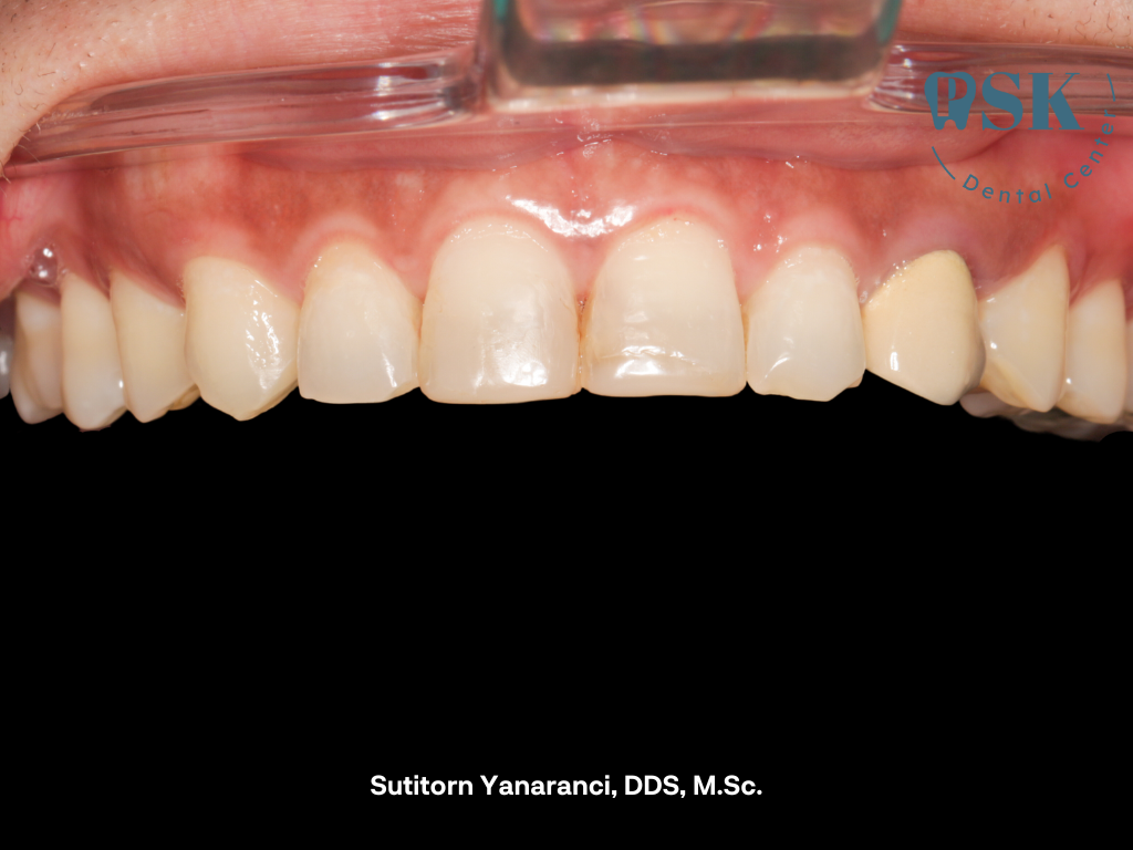 ตัดเหงือกเพิ่มความยาวฟัน Before การตัดเหงือกเพิ่มความยาวของตัวฟัน ที่คลินิกทันตกรรมพีเอสเค PSK Dental Center