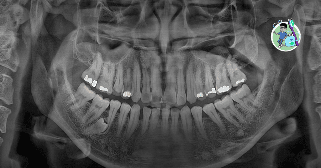 ฟันฝังคืออะไร อันตรายไหม ผ่าฟันฝัง ผ่าฟันคุด คุยกับหมอไกด์ คลินิกทันตกรรมพีเอสเค PSK Dental Center