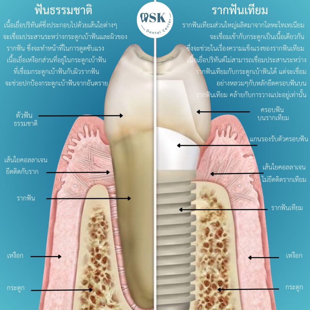 รากฟันเทียมต่างจากฟันธรรมชาติอย่างไร รากฟันเทียมกับฟันธรรมชาติมีความแตกต่างกันอย่างไร