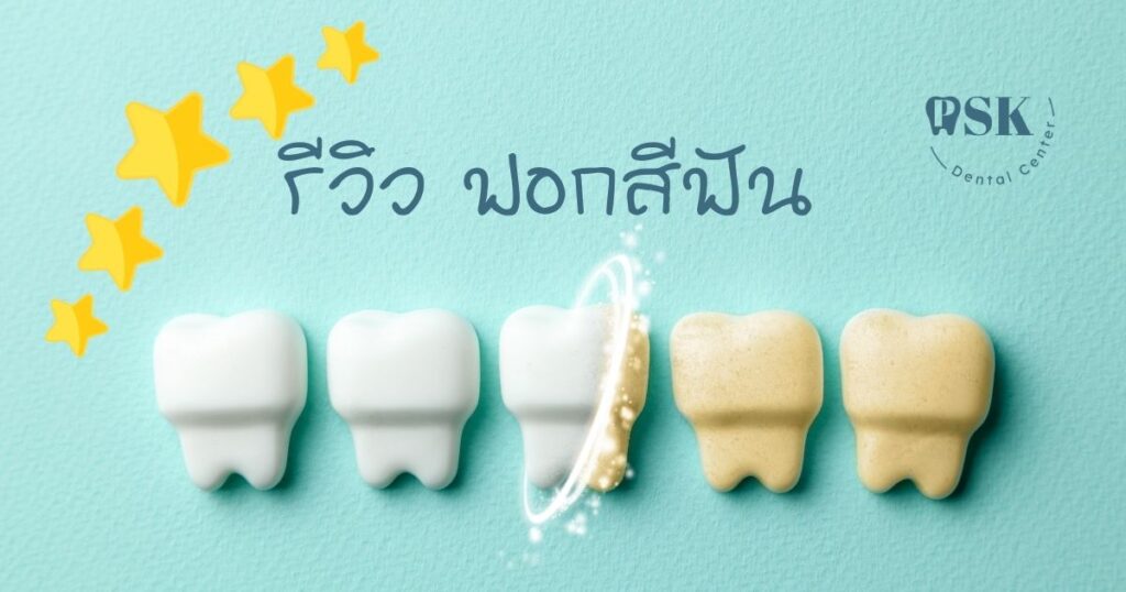 รีวิวฟอกสีฟัน - ผลลัพธ์ที่มีจากการฟอกสีฟัน และคำแนะนำเกี่ยวกับวิธีการฟอกสีฟันให้ขาวสว่าง