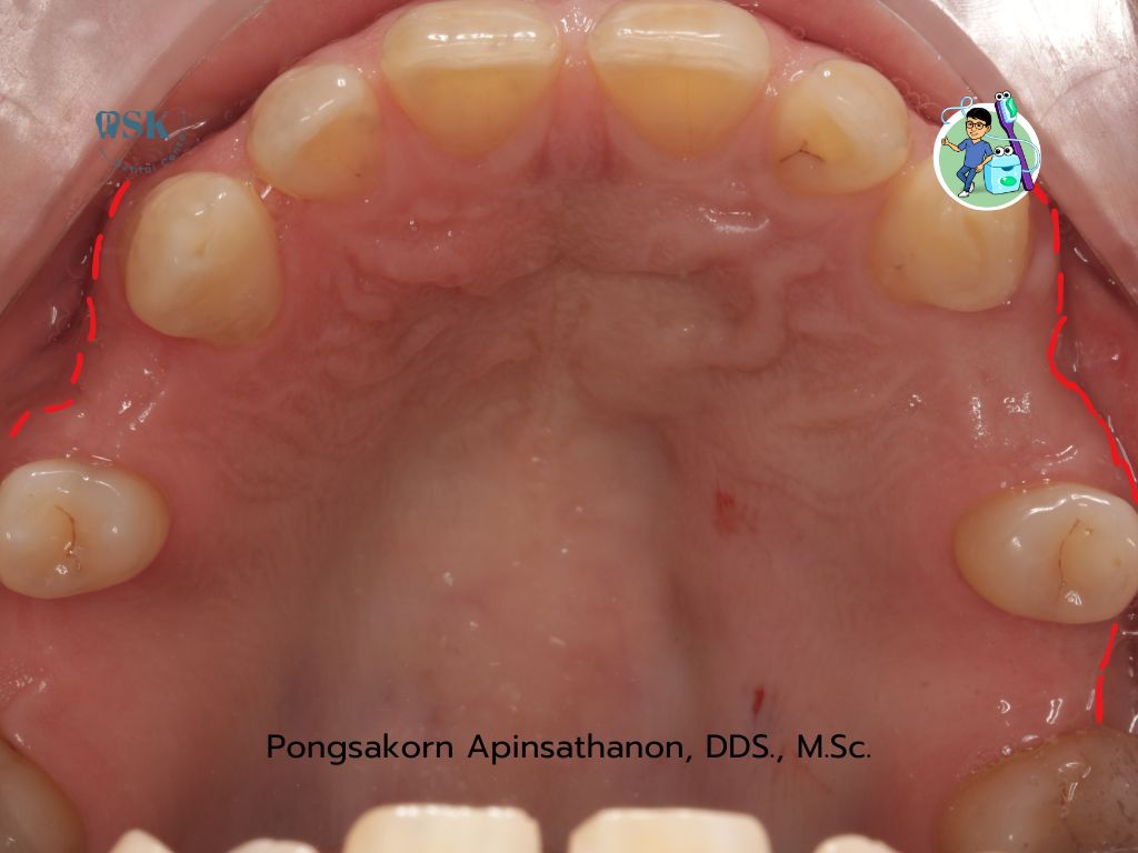 รีวิวการรักษาก่อนฝังรากฟันเทียมกับหมอไกด์ ที่คลินิกทันตกรรมพีเอสเค PSK Dental Center