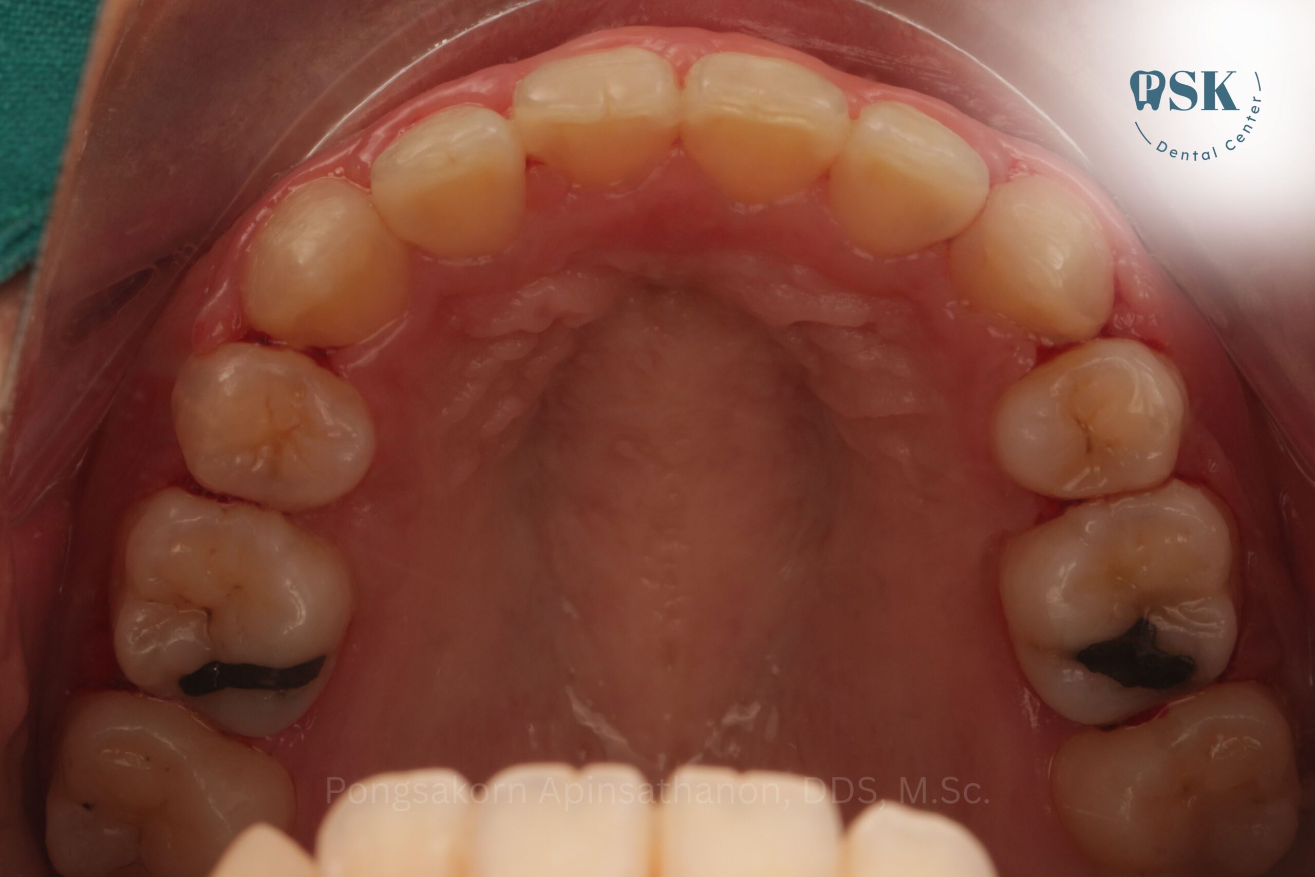 ย้ายเคสจัดฟันมาที่คลินิกทันตกรรมพีเอสเค | PSK Dental Center กับหมอไกด์ ทันตแพทย์พงศกร อภิญสถานนท์