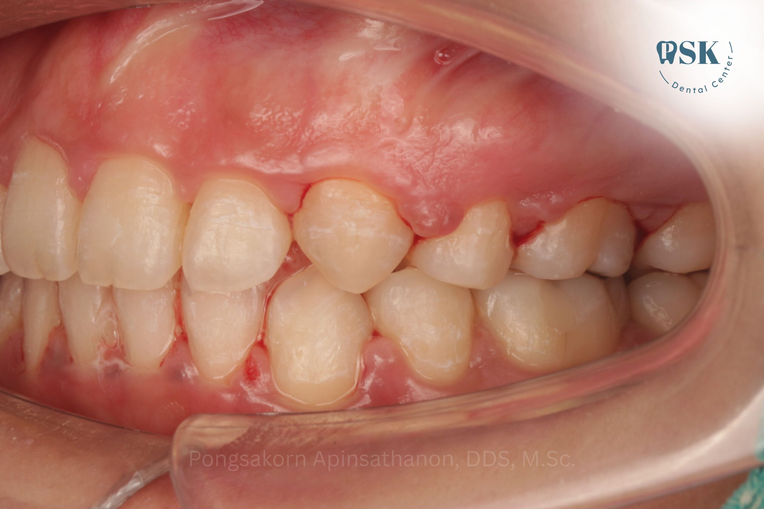 ย้ายเคสจัดฟันมาที่คลินิกทันตกรรมพีเอสเค | PSK Dental Center กับหมอไกด์ ทันตแพทย์พงศกร อภิญสถานนท์