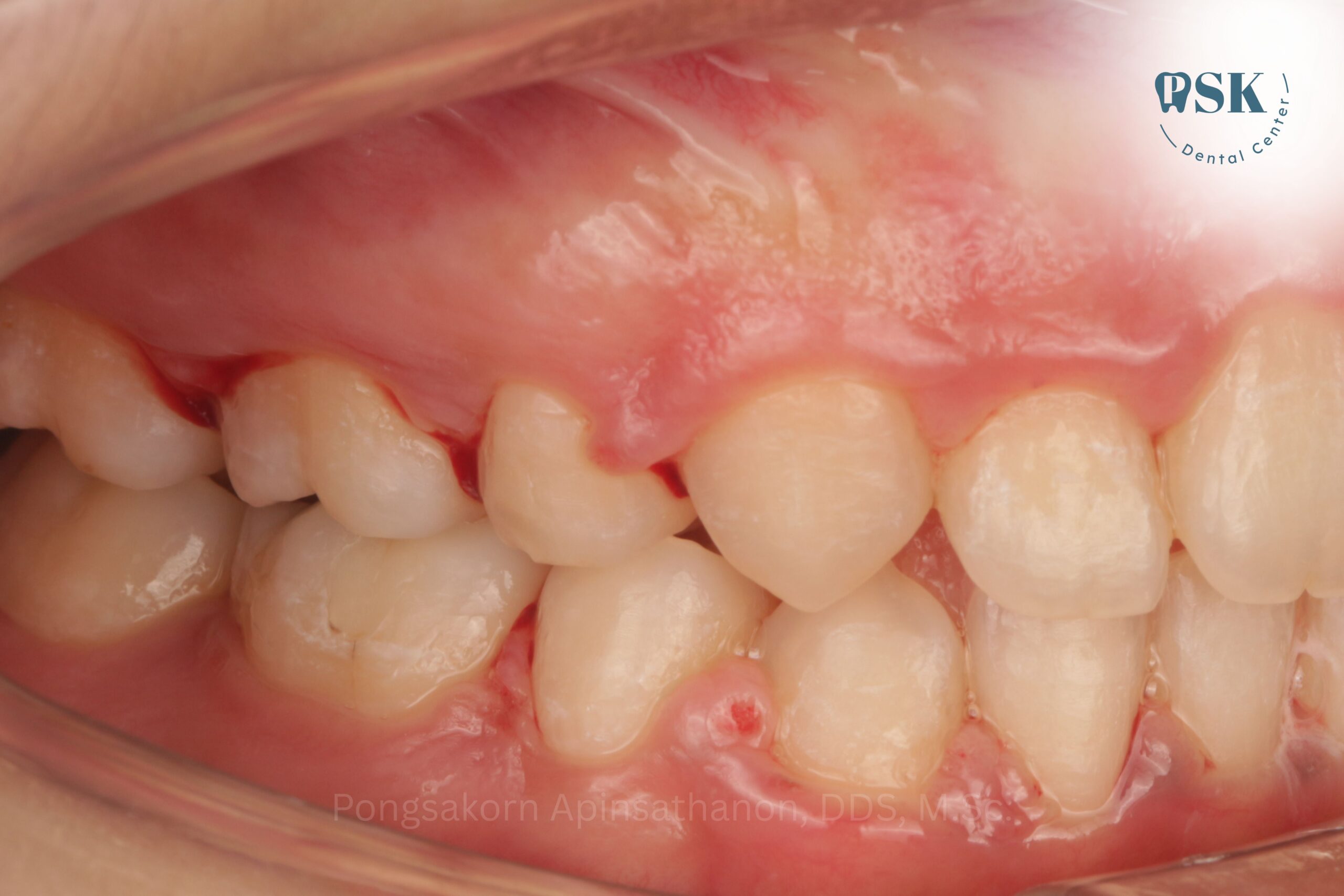 ย้ายเคสจัดฟันมาที่คลินิกทันตกรรมพีเอสเค | PSK Dental Center กับหมอไกด์ ทันตแพทย์พงศกร อภิญสถานนท์