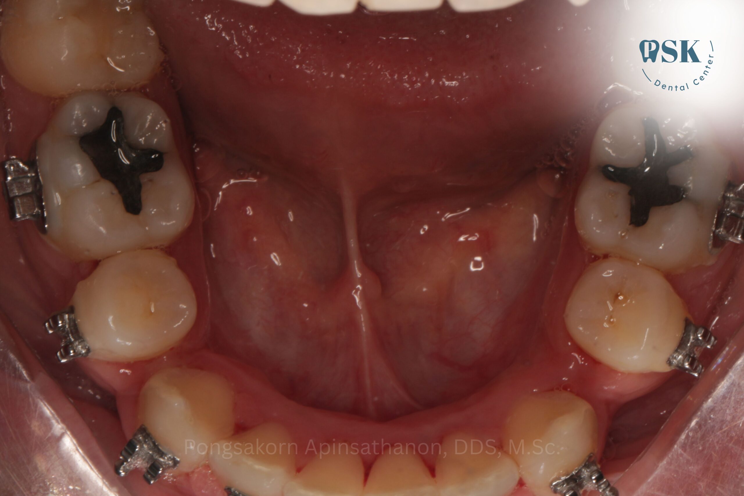ย้ายเคสจัดฟันมาที่คลินิกทันตกรรมพีเอสเค | PSK Dental Center กับหมอไกด์ ทันตแพทย์พงศกร อภิญสถานนท์